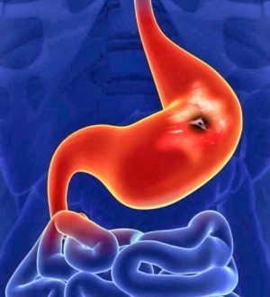 The FASTEST Way to Heal an Ulcer