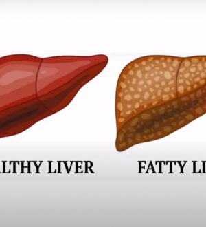 The BEST Foods for a Fatty Liver