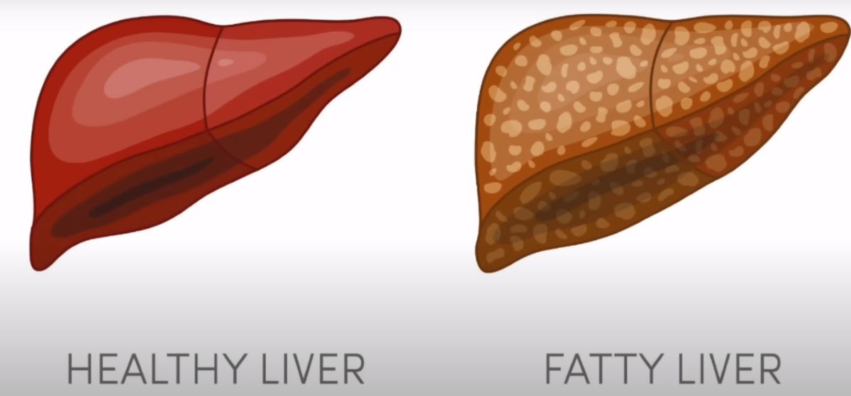 Fatty liver