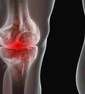 The Hidden Cause of Arthritis in Your Knees and Hands