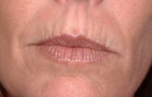 vertical wrinkles around the mouth