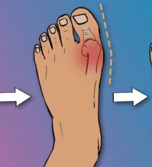 How to Fix Bunions in 3 Steps