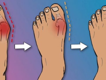 How to Fix Bunions in 3 Steps