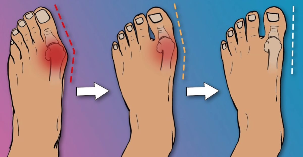 what causes bunions and how to get rid of them